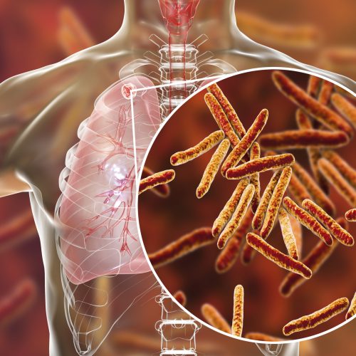 Diagnóstico y tratamiento de la tuberculosis